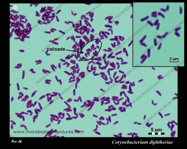 Corynebacterium diphtheriae Gram stain. Micrograph of Corynebacterium diphtheriae. C.diphtheriae